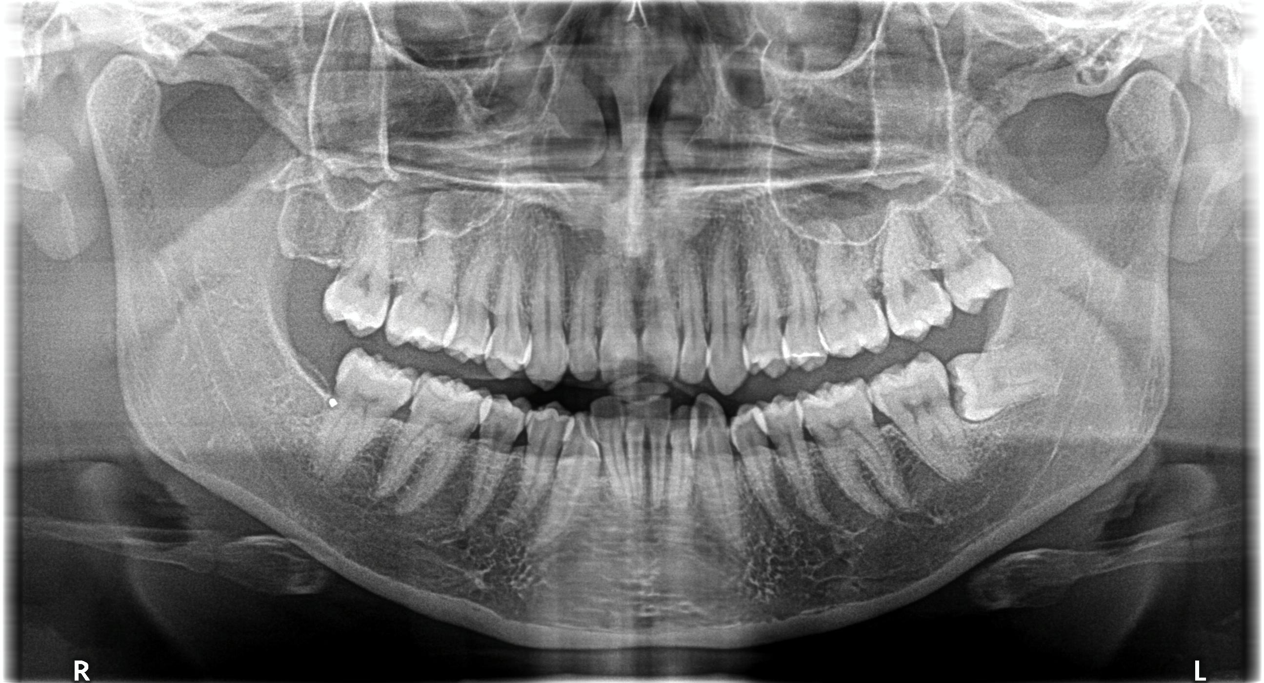 Radiografía panorámica de terceros molares